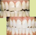 istanbul, kadıköy, moda, diş, diş hekimi, dişçi, diş doktoru, diş hastanesi, diş kliniği, randevu, ağız sağlığı, diş sağlığı, ağız ve diş sağlığı, diş tedavisi, porselen diş, diş kaplama, kaplama diş, lamina diş, lamine diş, diş beyazlatma, diş parlatma, implant diş, takma diş, gülüş estetiği, diş estetiği, dolgu diş, diş dolgusu, diş eti çekilmesi, diş eti kanaması, diş eti iltihabı, diş iltihabı, diş apse, diş eti tedavisi, kanal tedavisi, çocuk diş, süt dişleri, süt dişi, ortodonti, diş teli, diş protez, protez diş, zirkonyum diş, çene cerrahisi, diş muayene, diş bakımı, diş lekeleri, kırık diş, diş kırıkları, aralık dişler, çarpık diş, diş taşı temizliği, diş taşı temizleme, tartar temizliği, tartar temizleme, diş gıcırdatma, diş çürüğü, köprü diş, azı dişi, çürük diş, diş ağrısı, köpek dişi