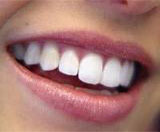 istanbul, kadıköy, moda, diş, diş hekimi, dişçi, diş doktoru, diş hastanesi, diş kliniği, randevu, ağız sağlığı, diş sağlığı, ağız ve diş sağlığı, diş tedavisi, porselen diş, diş kaplama, kaplama diş, lamina diş, lamine diş, diş beyazlatma, diş parlatma, implant diş, takma diş, gülüş estetiği, diş estetiği, dolgu diş, diş dolgusu, diş eti çekilmesi, diş eti kanaması, diş eti iltihabı, diş iltihabı, diş apse, diş eti tedavisi, kanal tedavisi, çocuk diş, süt dişleri, süt dişi, ortodonti, diş teli, diş protez, protez diş, zirkonyum diş, çene cerrahisi, diş muayene, diş bakımı, diş lekeleri, kırık diş, diş kırıkları, aralık dişler, çarpık diş, diş taşı temizliği, diş taşı temizleme, tartar temizliği, tartar temizleme, diş gıcırdatma, diş çürüğü, köprü diş, azı dişi, çürük diş, diş ağrısı, köpek dişi