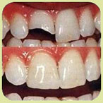 istanbul, kadıköy, moda, diş, diş hekimi, dişçi, diş doktoru, diş hastanesi, diş kliniği, randevu, ağız sağlığı, diş sağlığı, ağız ve diş sağlığı, diş tedavisi, porselen diş, diş kaplama, kaplama diş, lamina diş, lamine diş, diş beyazlatma, diş parlatma, implant diş, takma diş, gülüş estetiği, diş estetiği, dolgu diş, diş dolgusu, diş eti çekilmesi, diş eti kanaması, diş eti iltihabı, diş iltihabı, diş apse, diş eti tedavisi, kanal tedavisi, çocuk diş, süt dişleri, süt dişi, ortodonti, diş teli, diş protez, protez diş, zirkonyum diş, çene cerrahisi, diş muayene, diş bakımı, diş lekeleri, kırık diş, diş kırıkları, aralık dişler, çarpık diş, diş taşı temizliği, diş taşı temizleme, tartar temizliği, tartar temizleme, diş gıcırdatma, diş çürüğü, köprü diş, azı dişi, çürük diş, diş ağrısı, köpek dişi