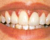 istanbul, kadıköy, moda, diş, diş hekimi, dişçi, diş doktoru, diş hastanesi, diş kliniği, randevu, ağız sağlığı, diş sağlığı, ağız ve diş sağlığı, diş tedavisi, porselen diş, diş kaplama, kaplama diş, lamina diş, lamine diş, diş beyazlatma, diş parlatma, implant diş, takma diş, gülüş estetiği, diş estetiği, dolgu diş, diş dolgusu, diş eti çekilmesi, diş eti kanaması, diş eti iltihabı, diş iltihabı, diş apse, diş eti tedavisi, kanal tedavisi, çocuk diş, süt dişleri, süt dişi, ortodonti, diş teli, diş protez, protez diş, zirkonyum diş, çene cerrahisi, diş muayene, diş bakımı, diş lekeleri, kırık diş, diş kırıkları, aralık dişler, çarpık diş, diş taşı temizliği, diş taşı temizleme, tartar temizliği, tartar temizleme, diş gıcırdatma, diş çürüğü, köprü diş, azı dişi, çürük diş, diş ağrısı, köpek dişi