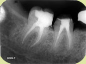 istanbul, kadıköy, moda, diş, diş hekimi, dişçi, diş doktoru, diş hastanesi, diş kliniği, randevu, ağız sağlığı, diş sağlığı, ağız ve diş sağlığı, diş tedavisi, porselen diş, diş kaplama, kaplama diş, lamina diş, lamine diş, diş beyazlatma, diş parlatma, implant diş, takma diş, gülüş estetiği, diş estetiği, dolgu diş, diş dolgusu, diş eti çekilmesi, diş eti kanaması, diş eti iltihabı, diş iltihabı, diş apse, diş eti tedavisi, kanal tedavisi, çocuk diş, süt dişleri, süt dişi, ortodonti, diş teli, diş protez, protez diş, zirkonyum diş, çene cerrahisi, diş muayene, diş bakımı, diş lekeleri, kırık diş, diş kırıkları, aralık dişler, çarpık diş, diş taşı temizliği, diş taşı temizleme, tartar temizliği, tartar temizleme, diş gıcırdatma, diş çürüğü, köprü diş, azı dişi, çürük diş, diş ağrısı, köpek dişi