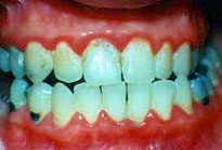 istanbul, kadıköy, moda, diş, diş hekimi, dişçi, diş doktoru, diş hastanesi, diş kliniği, randevu, ağız sağlığı, diş sağlığı, ağız ve diş sağlığı, diş tedavisi, porselen diş, diş kaplama, kaplama diş, lamina diş, lamine diş, diş beyazlatma, diş parlatma, implant diş, takma diş, gülüş estetiği, diş estetiği, dolgu diş, diş dolgusu, diş eti çekilmesi, diş eti kanaması, diş eti iltihabı, diş iltihabı, diş apse, diş eti tedavisi, kanal tedavisi, çocuk diş, süt dişleri, süt dişi, ortodonti, diş teli, diş protez, protez diş, zirkonyum diş, çene cerrahisi, diş muayene, diş bakımı, diş lekeleri, kırık diş, diş kırıkları, aralık dişler, çarpık diş, diş taşı temizliği, diş taşı temizleme, tartar temizliği, tartar temizleme, diş gıcırdatma, diş çürüğü, köprü diş, azı dişi, çürük diş, diş ağrısı, köpek dişi